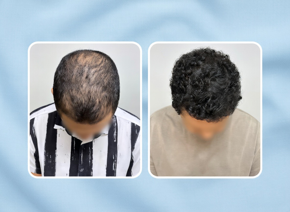 Resultado implante capilar TCD Brasil