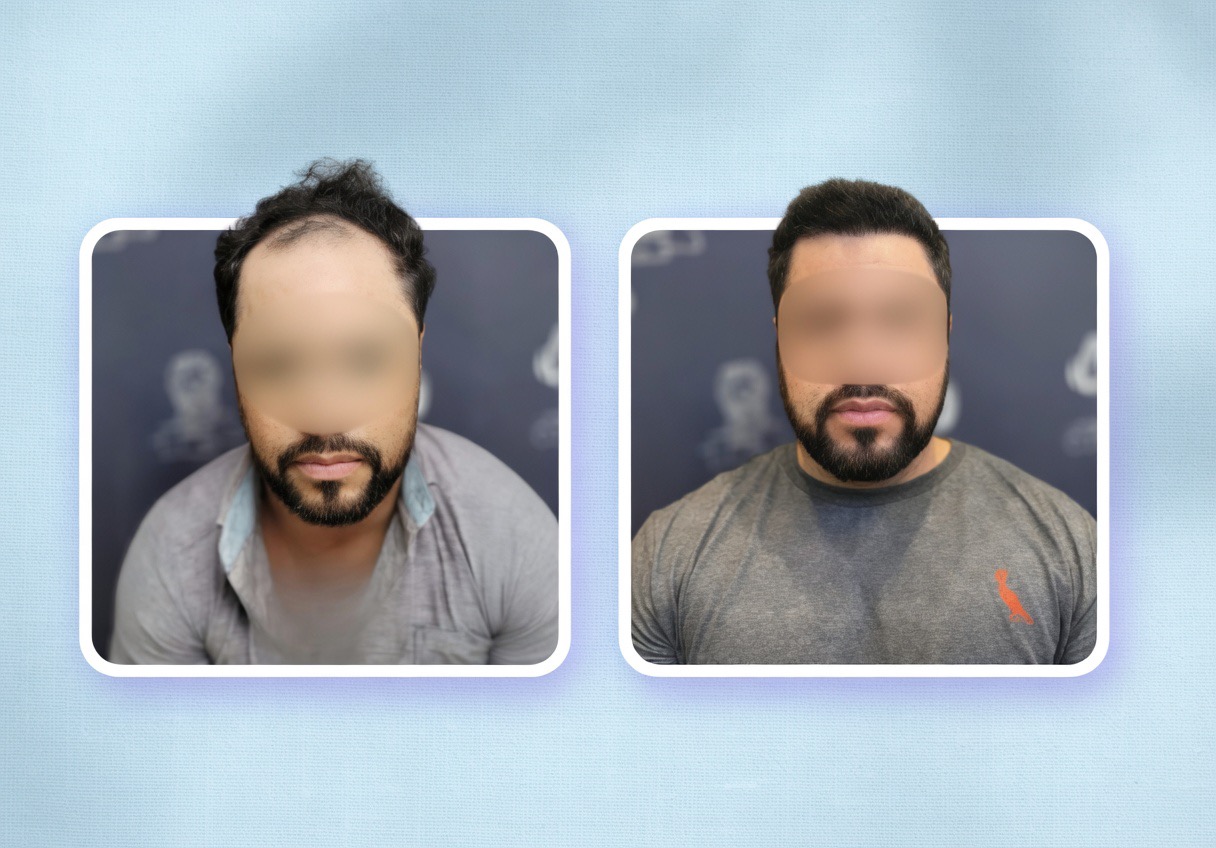 Antes e depois implante capilar