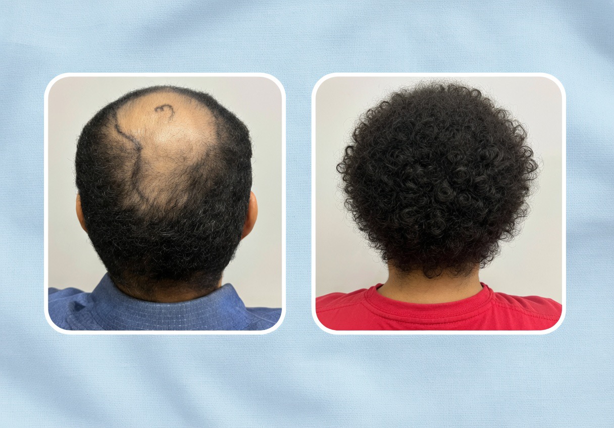 Resultado transplante capilar SP