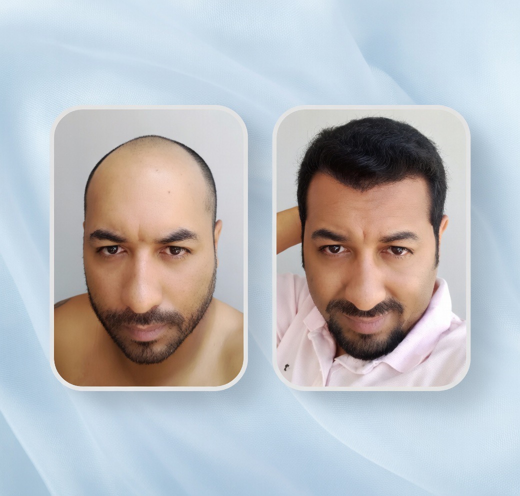 Implante capilar caneta Implanter