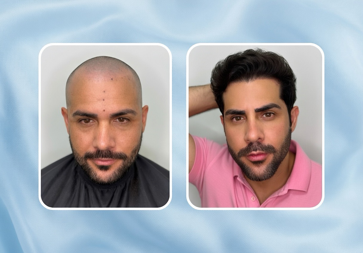 TCD Brasil antes e depois