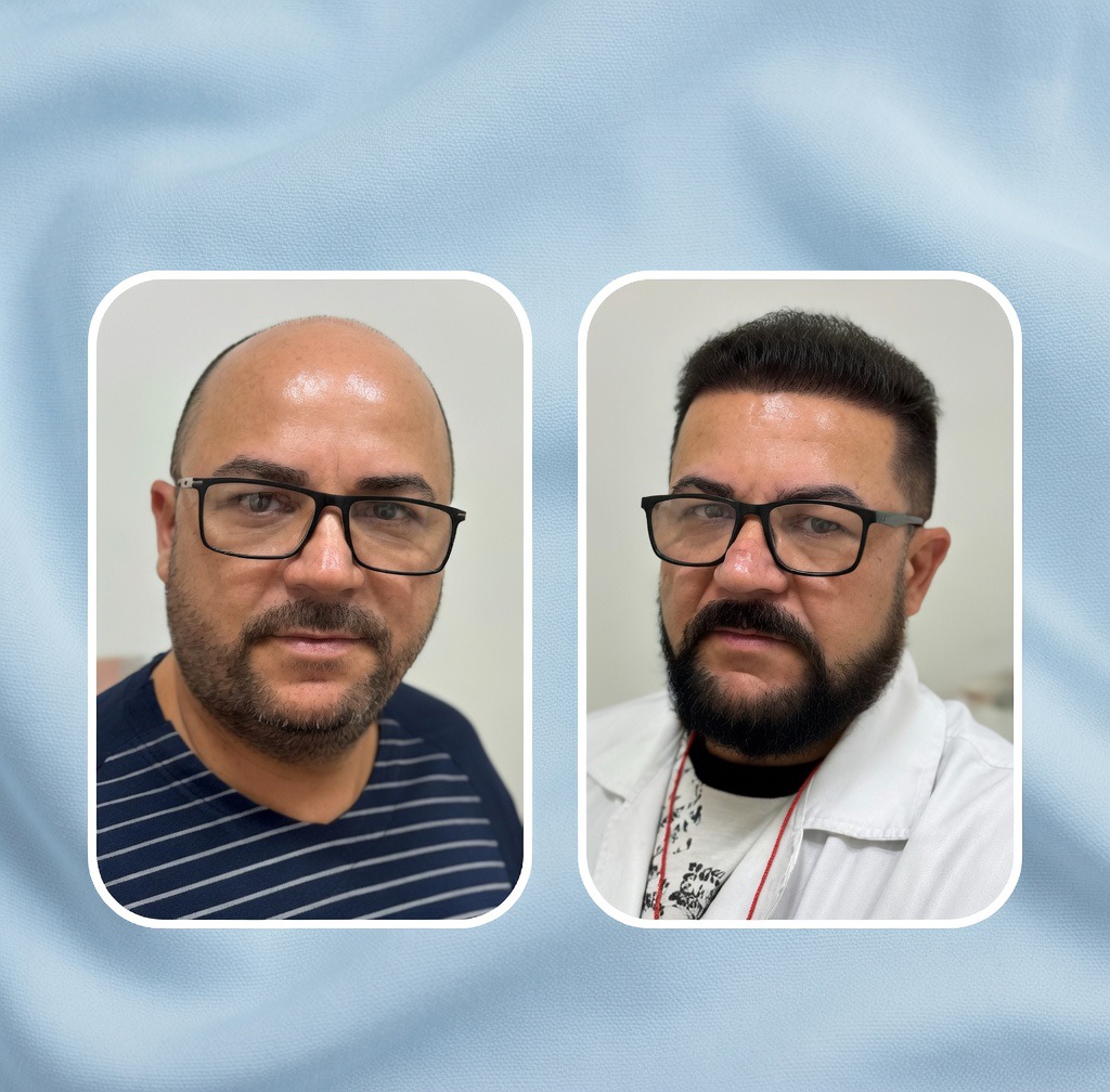 Resultado natural implante capilar