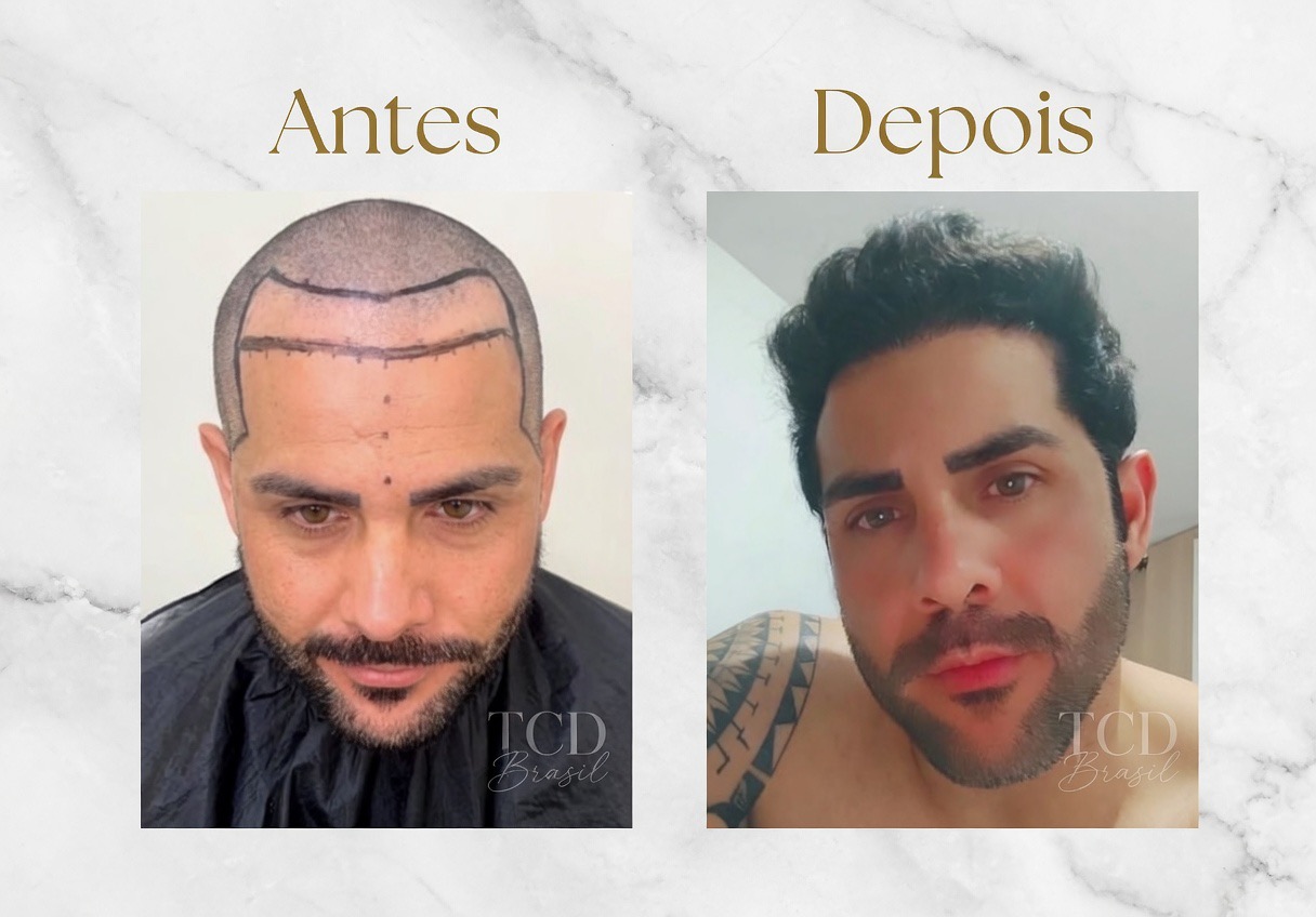 Resultado real implante capilar TCD Brasil