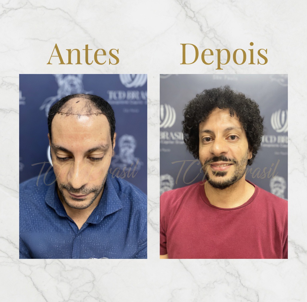 Resultado transplante capilar Indianópolis
